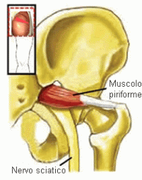 sindrome-del-piriforme