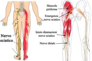 cause-sciatica
